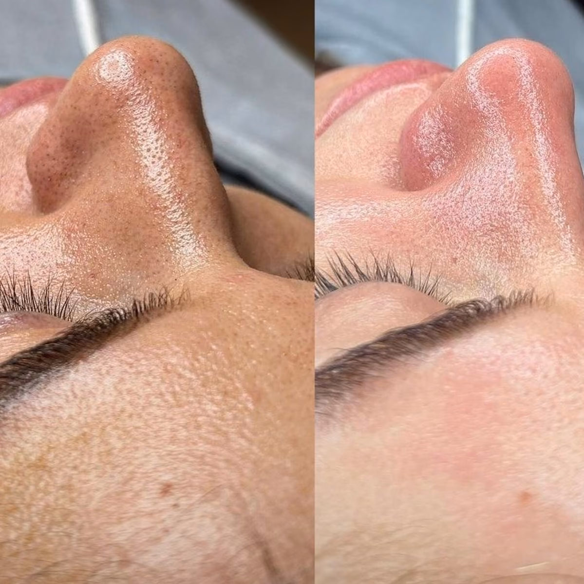 Resultado de una limpieza facial en el Estudio Antonella Paludi
