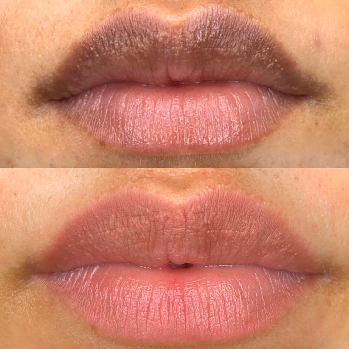 Neutralización de labios oscuros con micropigmentación en el Estudio Antonella Paludi