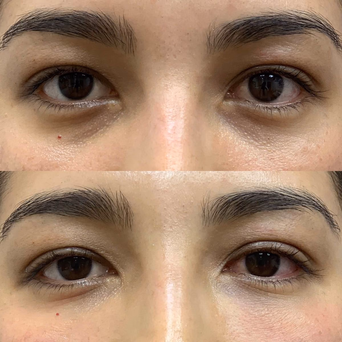 Antes y después de un aclarado de ojeras en el Estudio Antonella Paludi